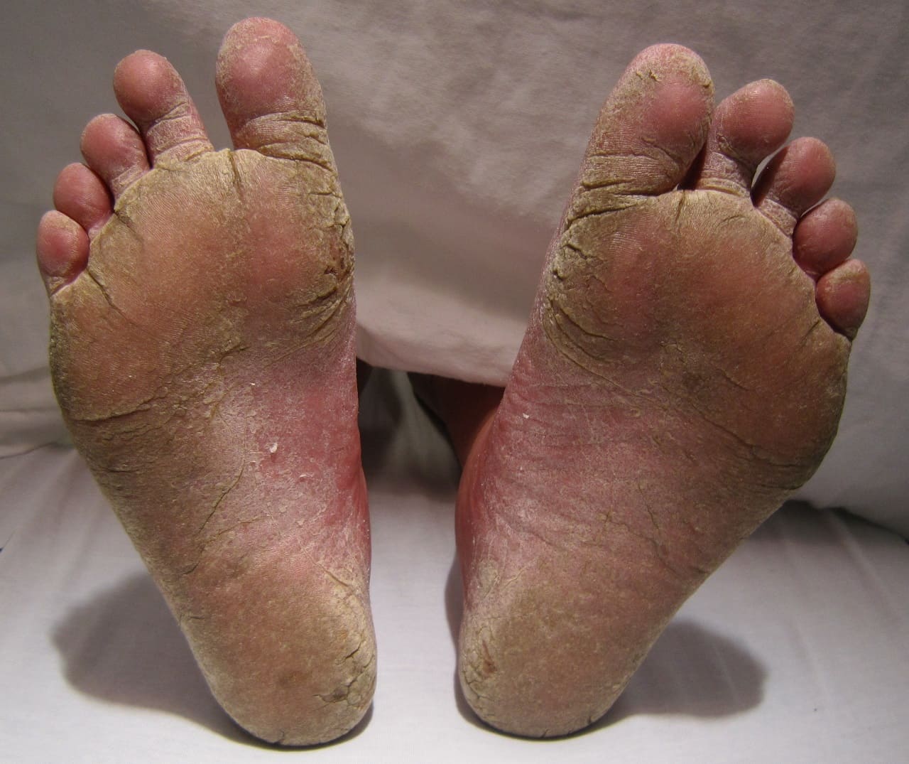 Fusspilz-Fusspilzerkrankung-Zehenzwischenraeume-Tinea-pedis-interdigitalis-Interdigitalmykose-Fusssohle-Fussgewoelbe-Kritisches-Netzwerk-Fusspilzerreger-Pilzinfektion