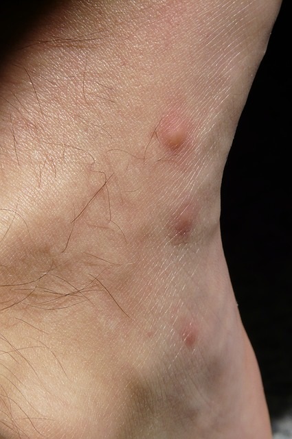 Insektenstich-Mueckenstich-Juckreiz-Jucken-Kribbeln-Entzuendung-Kritisches-Netzwerk-Reizung-Nozizeptoren-somatosensorische-Empfindung-freie-Nervenenden-Histamin