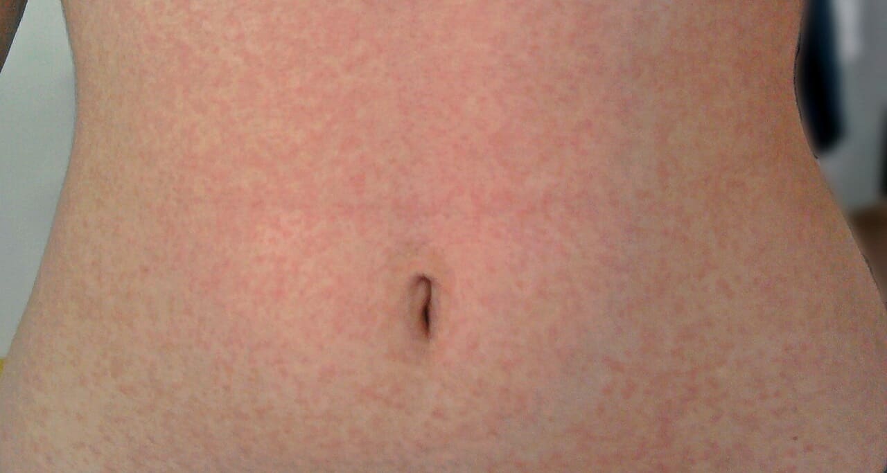 Masern_Masernerkrankung_Masernhysterie_Masernimpfquote_Masernimpfung_Masernimpfzwang_Maserninfektion_Masernpflichtimpfung_Masernvirus_Kritisches-Netzwerk